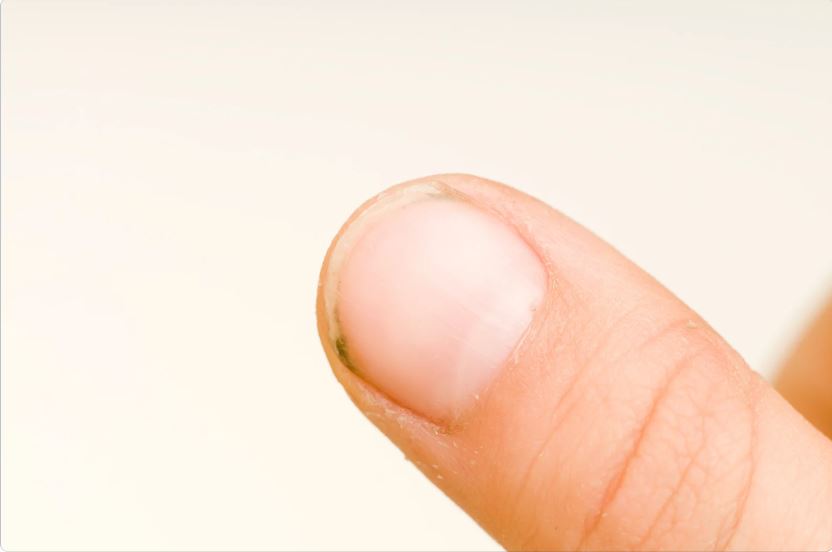 ongle-gros-doigt